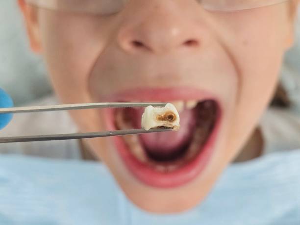 Best Emergency Dental Care for Broken or Chipped Teeth in Buena Vista, MI